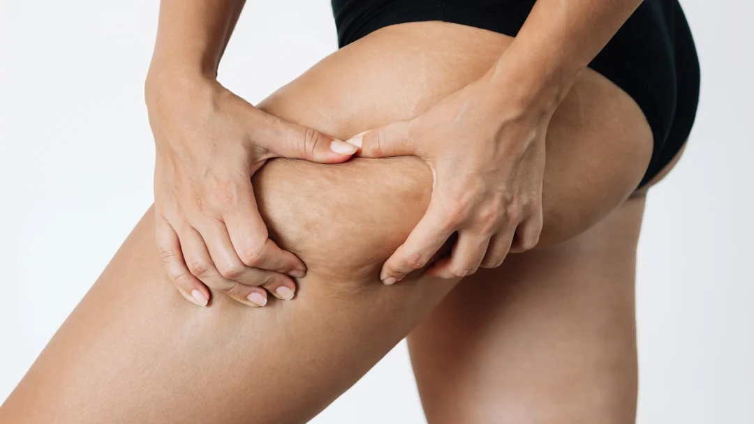 Femme montrant de la cellulite fibreuse sur ses cuisses, illustrant une texture de peau irrégulière.
