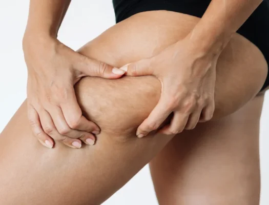 A woman showing fibrous cellulite on her thighs, highlighting the texture and appearance of the skin.