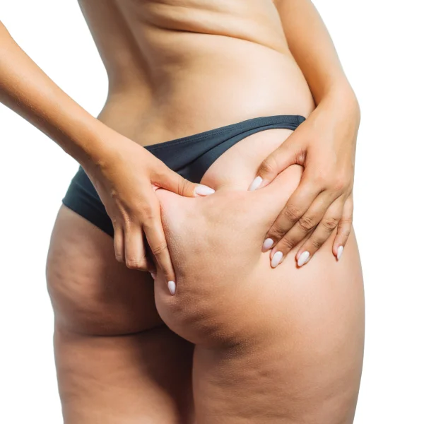 A woman showing fibrous cellulite on her buttocks, highlighting the texture and appearance of the skin.
