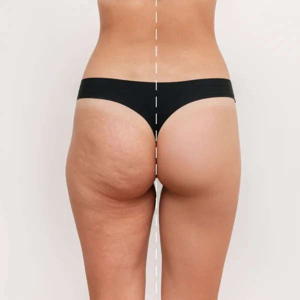 Image montrant un avant et après d'un resserrement des fesses, mettant en évidence l'amélioration de la cellulite fibreuse.
