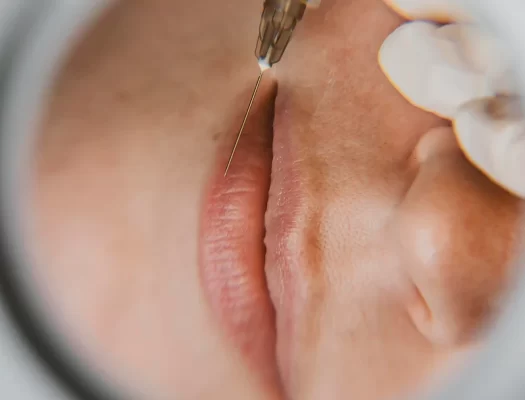 Close-up of a woman's face receiving a dermal filler injection with a needle, highlighting her skin and expression.